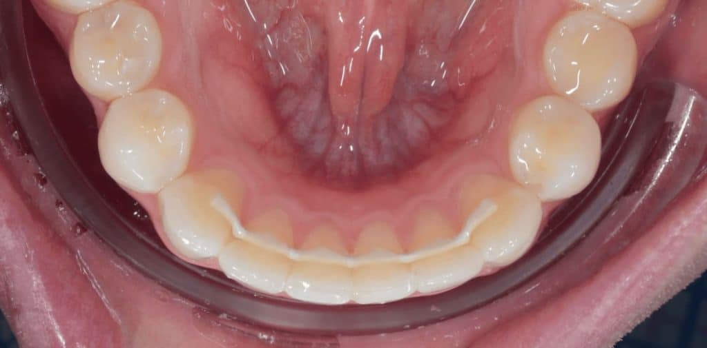 Fils de contention PEEK sur-mesure